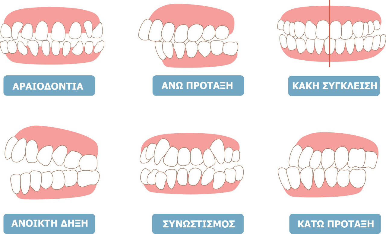 Invisalign θεραπείες ορθοδοντικής στον Πειραιά