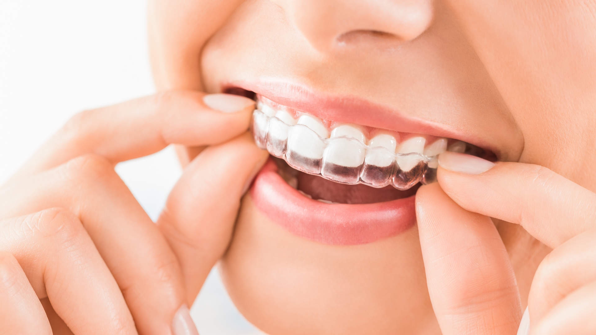 Ορθοδοντικές Θεραπείες | Αdvanced Dental Clinics