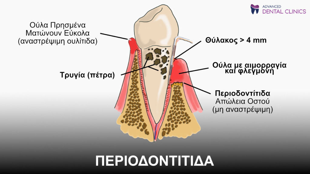 Απεικόνιση της περιοδοντίτιδας